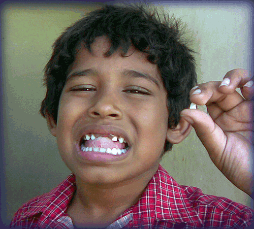 My 4th Teeth is now Gone